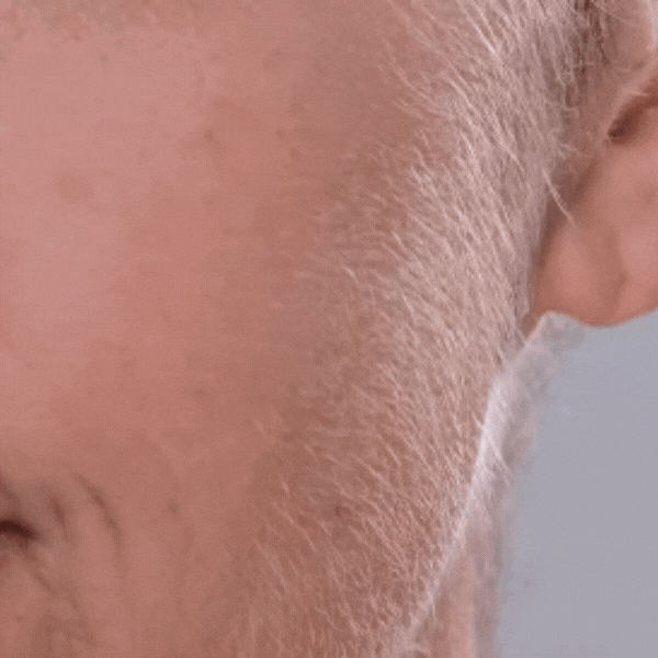 BareBliss™ | Stop 97% of hormonal hair growth at the root in just 4 days